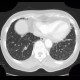 Carcinomatous lymphangoitis, lymphangoitis carcinosa, osteolysis of shoulder blade: CT - Computed tomography